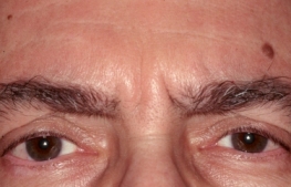 Botox Procedure, Before Operation