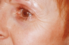 Laser resurfacing before operation