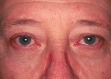 Lower Blepharoplasty After Operation