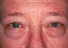 Lower Blepharoplasty Before Operation