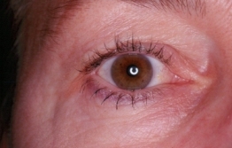 Upper Blepharoplasty Before Operation